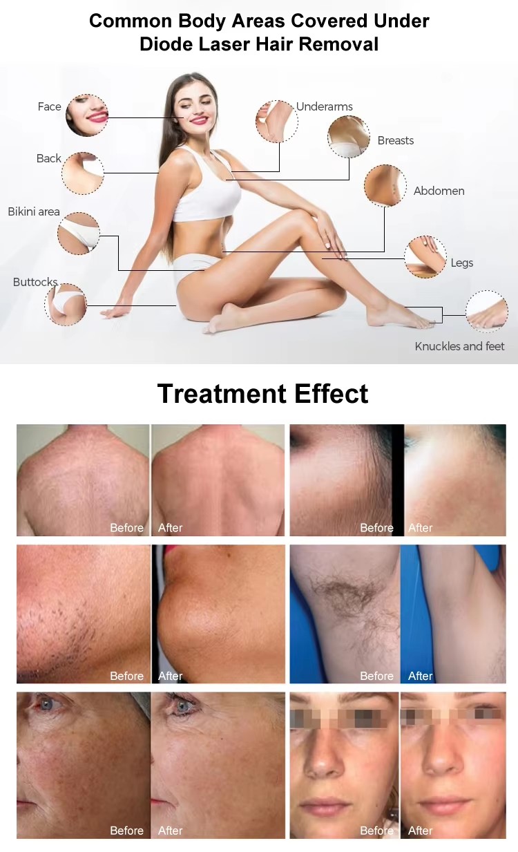 Diode Laser Device08